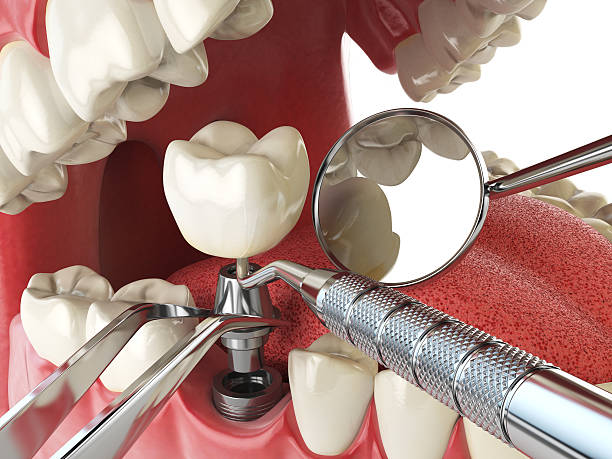 Best Dentist for Tooth Abscess  in Minerva Park, OH